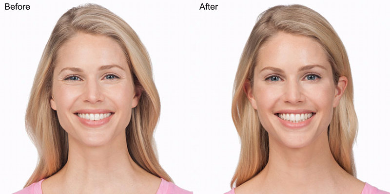 BOTOX® Cosmetic Injections Before and After Photo by Original Skin Med Spa and Laser Clinic in Broomfield CO
