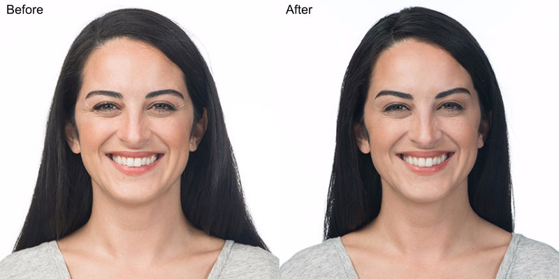BOTOX® Cosmetic Injections Before and After Photo by Original Skin Med Spa and Laser Clinic in Broomfield CO