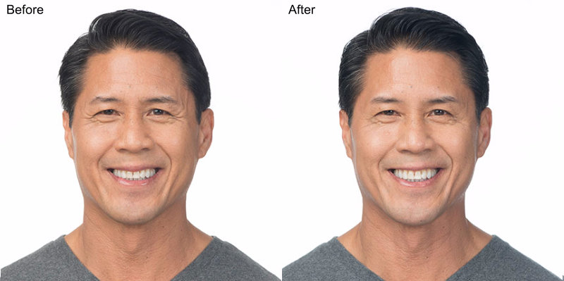 BOTOX® Cosmetic Injections Before and After Photo by Original Skin Med Spa and Laser Clinic in Broomfield CO