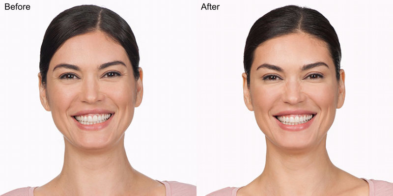 BOTOX® Cosmetic Injections Before and After Photo by Original Skin Med Spa and Laser Clinic in Broomfield CO