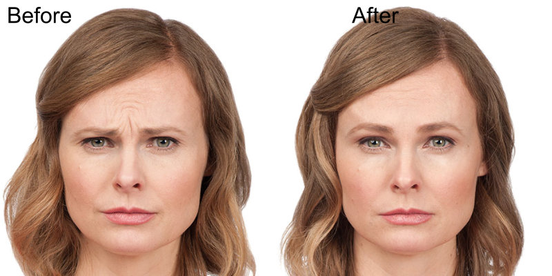 BOTOX® Cosmetic Injections Before and After Photo by Original Skin Med Spa and Laser Clinic in Broomfield CO