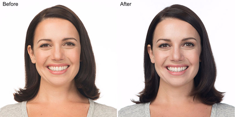 BOTOX® Cosmetic Injections Before and After Photo by Original Skin Med Spa and Laser Clinic in Broomfield CO