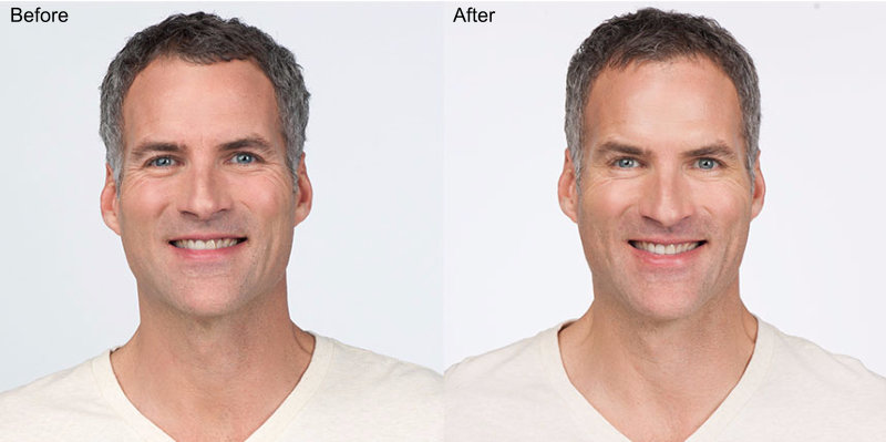 BOTOX® Cosmetic Injections Before and After Photo by Original Skin Med Spa and Laser Clinic in Broomfield CO