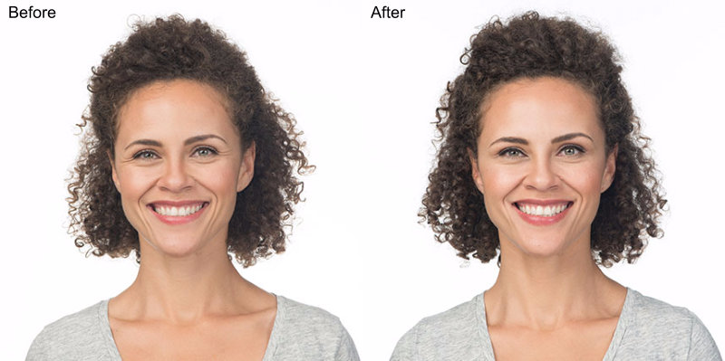 BOTOX® Cosmetic Injections Before and After Photo by Original Skin Med Spa and Laser Clinic in Broomfield CO