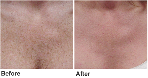 Intense Pulsed Light IPL Before and After Photo by Original Skin Med Spa and Laser Clinic in Broomfield CO