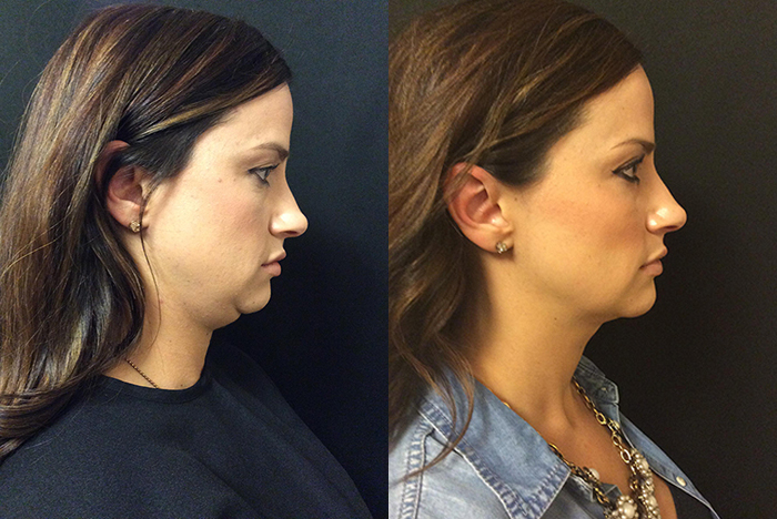 Kybella Injections Before and After Photo by Original Skin Med Spa and Laser Clinic in Broomfield CO