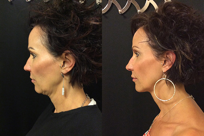 Kybella Injections Before and After Photo by Original Skin Med Spa and Laser Clinic in Broomfield CO