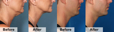 Kybella Injections Before and After Photo by Original Skin Med Spa and Laser Clinic in Broomfield CO