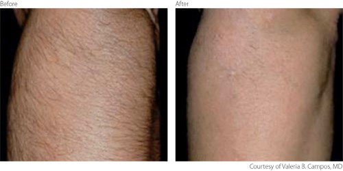 Laser Hair Removal Before and After Photo by Original Skin Med Spa and Laser Clinic in Broomfield CO