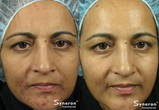 eMatrix Sublative Rejuvenation Before and After Photo by Original Skin Med Spa and Laser Clinic in Broomfield CO