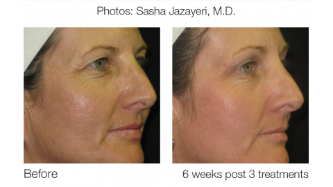 eMatrix Sublative Rejuvenation Before and After Photo by Original Skin Med Spa and Laser Clinic in Broomfield CO