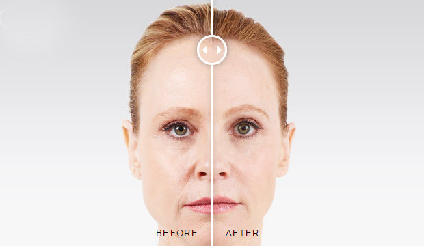 Juvederm® Injections Before and After Photo by Original Skin Med Spa and Laser Clinic in Broomfield CO