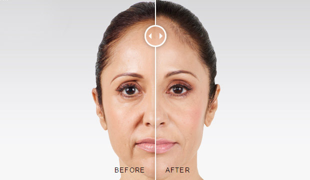 Juvederm® Injections Before and After Photo by Original Skin Med Spa and Laser Clinic in Broomfield CO