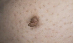Skin Tag